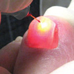 Nail Fungus Laser