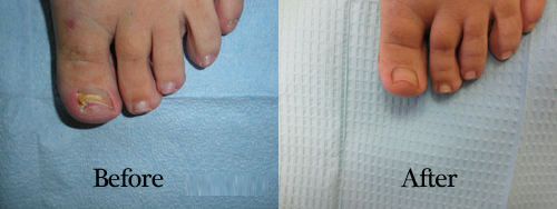 Before Nail Fungus Treatment Before Nail Fungus Treatment