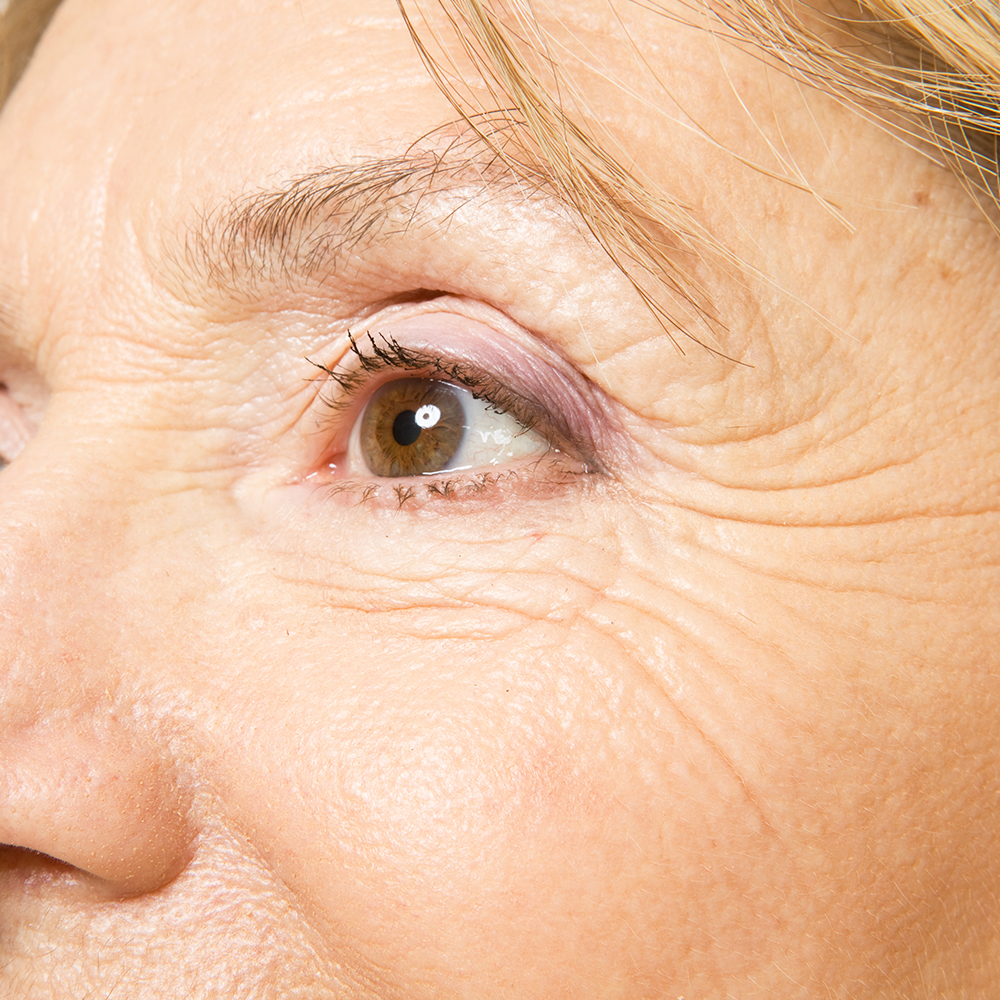 Wrinkles from Age & Sun Exposure | California Skin Institute