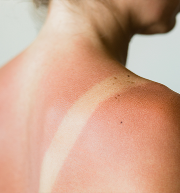 How To Stop the Pain and Get Sunburn Relief Naturally - The How-To Home
